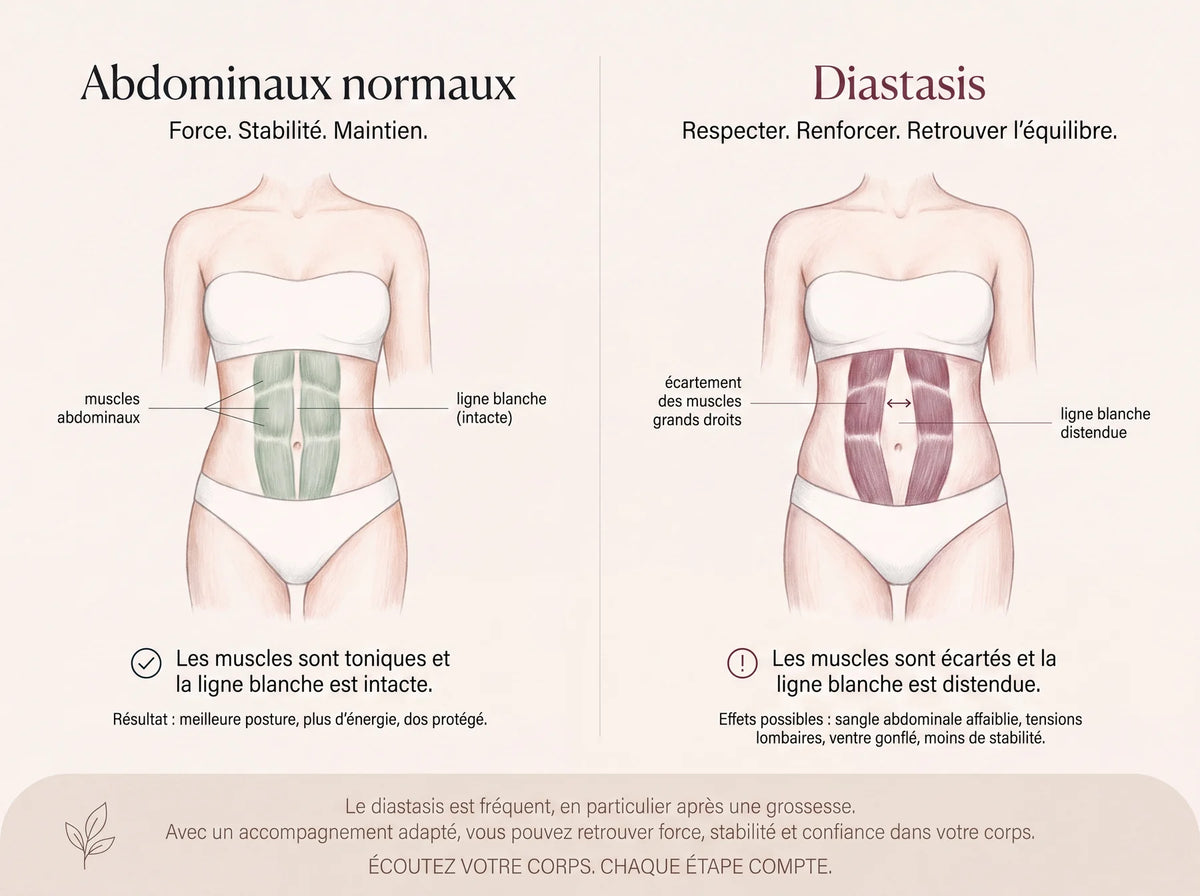 Schéma comparatif : abdominaux normaux et diastasis